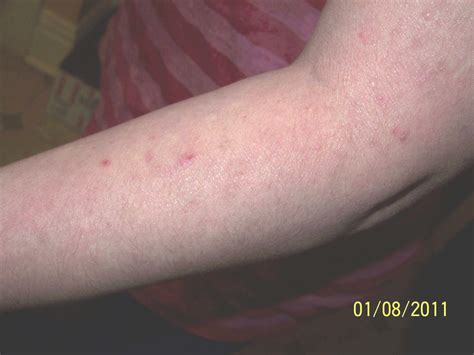 armpit shingles|pictures of brachioradial pruritus.